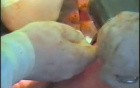 Gastric Cancer Surgery - Distal Gastrectomy
