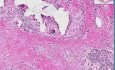 Breast - Foreign body reaction
