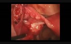 Linear Salpingostomy - Ectopic Tubal Pregnancy