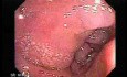 Multiple Adenomatous Polyps Of The Rectum (6 of 37)