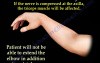 Radial Nerve Palsy - Saturday Night Palsy - Part 1