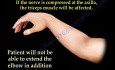 Radial Nerve Palsy - Saturday Night Palsy - Part 1
