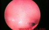 Hysteroscopy for Diagnostic Purposes
