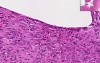 Chronic Fibrinous Bursitis