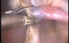 Total Hysterectomy With Erbe Seeling System