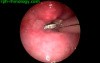 Foreign Body In Esophagus