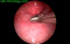 Foreign Body In Esophagus