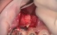 Periapical Granuloma Removal And Bone Grafting