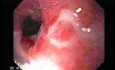 Benign Esophageal Stricture - Result Of GERD