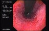 Barrett's Esophagus of long segment (3 of 24)