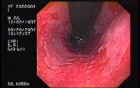 Barrett's Esophagus of long segment (3 of 24)