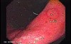 Gastric Polyp (1 of 7)