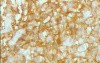 Lymphoma B small cells of the Jejuno (10 of 10)