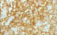 Lymphoma B small cells of the Jejuno (10 of 10)