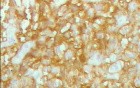 Lymphoma B small cells of the Jejuno (10 of 10)
