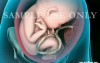 Breech Birth Position 