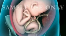 Breech Birth Position 