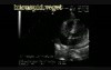 Infective Endocarditis: Large Vegetation On The Tricuspid Valve