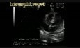 Infective Endocarditis: Large Vegetation On The Tricuspid Valve