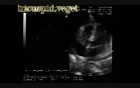 Infective Endocarditis: Large Vegetation On The Tricuspid Valve