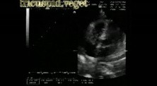 Infective Endocarditis: Large Vegetation On The Tricuspid Valve