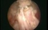 Transurethral Resection of the Prostate - TURP 