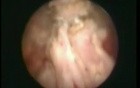 Transurethral Resection of the Prostate - TURP 
