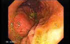 Gastrointestinal Stromal Tumor - GIST (2 of 13)