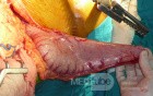 Adenocarcinoma of the cardias and gastric fundus with signet-ring cells (6 of 25)