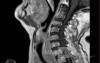 Esophageal Squamous Cell Carcinoma of the the upper third of the Esophagus that invades the subglotic (6 of 8)