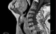 Esophageal Squamous Cell Carcinoma of the the upper third of the Esophagus that invades the subglotic (6 of 8)