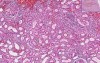 Interstitial Nephritis