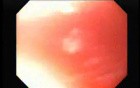 Achalasia - residual food (7 of 11)
