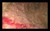 EUS-Guided Necrosectomy