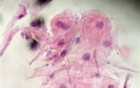 Esophageal Candidiasis Infected with Bacteria (5 of 6)