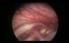 Endoscopy Inside The Brain