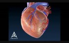 Coronary Plaque - 3D Medical Animation