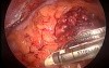 Laparoscopic abdominoperineal resection