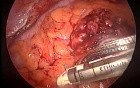 Laparoscopic abdominoperineal resection