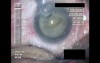 Cataract Surgery IX - Part 2
