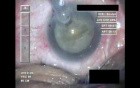 Cataract Surgery IX - Part 2