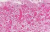 Empyema With Organized Granulation Tissue
