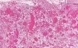 Empyema With Organized Granulation Tissue