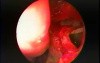 Maxillary Sinus Antrostomy - Intranasal, Endoscopic