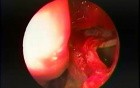 Maxillary Sinus Antrostomy - Intranasal, Endoscopic