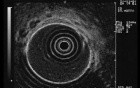 Long Standing Alcohol Abuse - Radial Endosonography, Part 2
