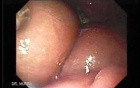 Abdominal Compartment Syndrome due to Malignancy (1 of 10)
