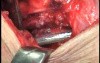 Perforation of a Esophageal Carcinoma after the procedure with hydrostatic balloon dilation (9 of 12)