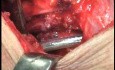 Perforation of a Esophageal Carcinoma after the procedure with hydrostatic balloon dilation (9 of 12)