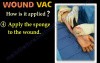 Hemovac Vs. Woundvac 